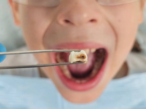 Best Tooth Infection Emergency Dentist  in Washington, MO